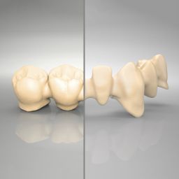 IPS e.max® ZirCAD Brückengerüste und verblockte Kronengerüste, 2 bis 16 Glieder, MO 4 