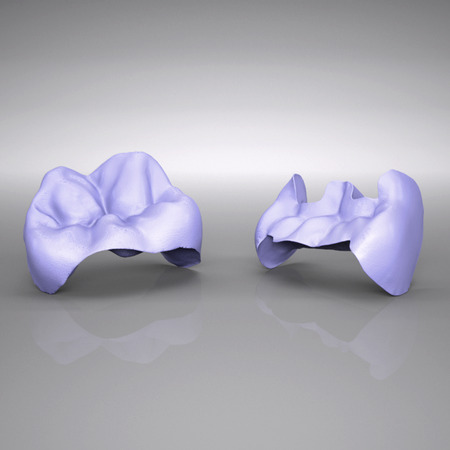 IPS e.max® CAD Inlays / Onlays, HT und LT 