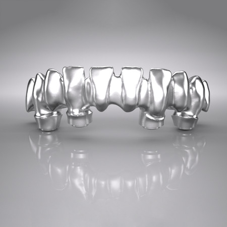 Brücken/-gerüste und verblockte Kronen/-gerüste, okklusal verschraubt, 2 bis 16 Glieder, Titanlegierung, mit Modellvermessung 