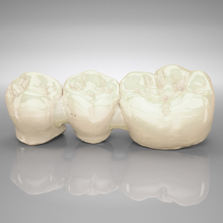 Telio® CAD Brücken und verblockte Kronen, 2 bis 16 Glieder, LT 