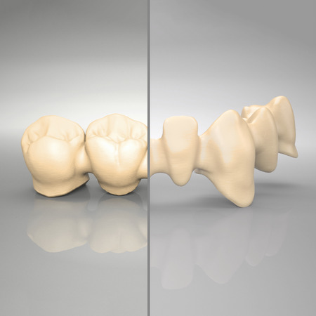 IPS e.max® ZirCAD Brückengerüste und verblockte Kronengerüste, 2 bis 16 Glieder, MO 4 