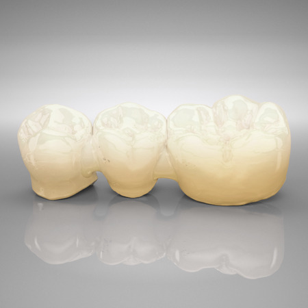 IPS e.max® ZirCAD Brücken und verblockte Kronen für Titanbasen, 2 und 3 Glieder, MT Multi 